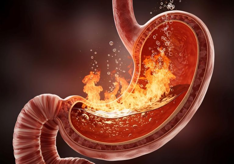 Pálenie záhy a reflux kyseliny, koncept ohňa v žalúdku, gastritída a GERD. Bolesť žalúdka a problém s trávením, lekárska ilustrácia kyslosti žalúdka a pocitu pálenia.